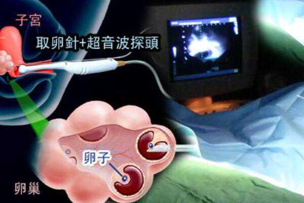 广州世纪助孕生殖中心,如何调理卵巢早衰助孕？