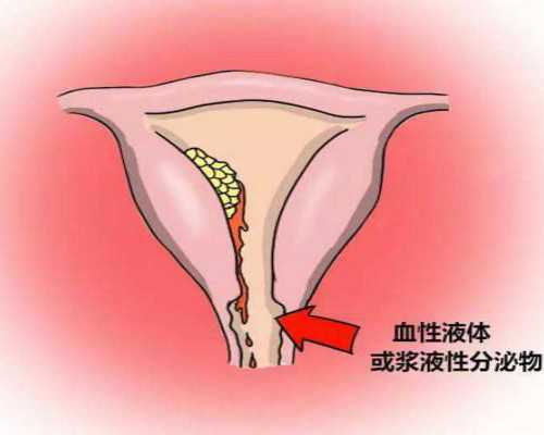 <strong>切除子宫寿命减少，女性切除子宫有5大危害</strong>