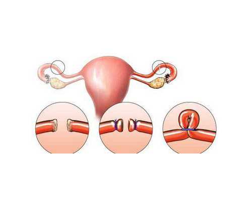 供卵不排队,做试管婴儿输卵管堵死