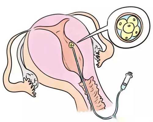 在同性用精子库的精子做试管婴儿全部费用大概多少钱？